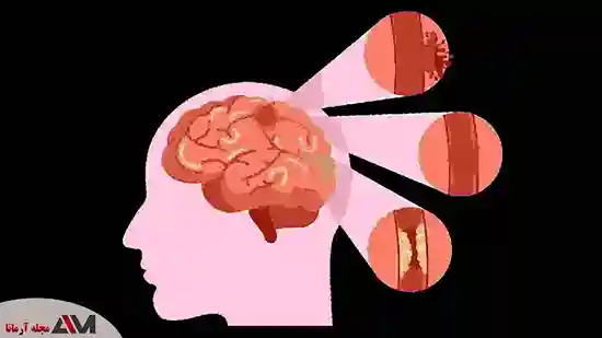 تشخیص علائم و نشانه های تومور مغزی