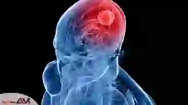 تشخیص و بررسی علائم تشنج مغزی و عصبی