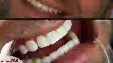بررسی تفاوت های بین کامپوزیت ونیر و کامپوزیت سرامیکی